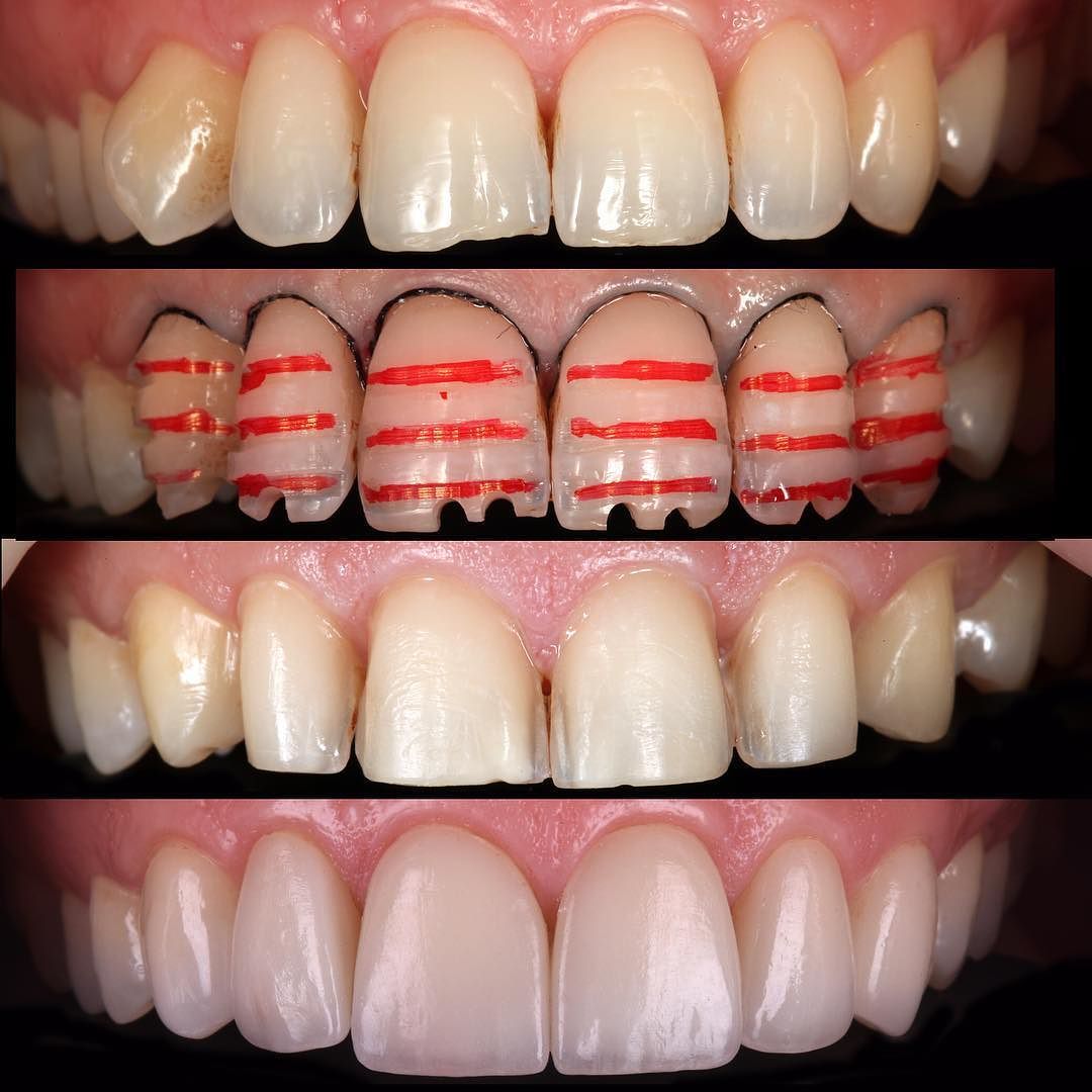 Veneers and Smile Makeover