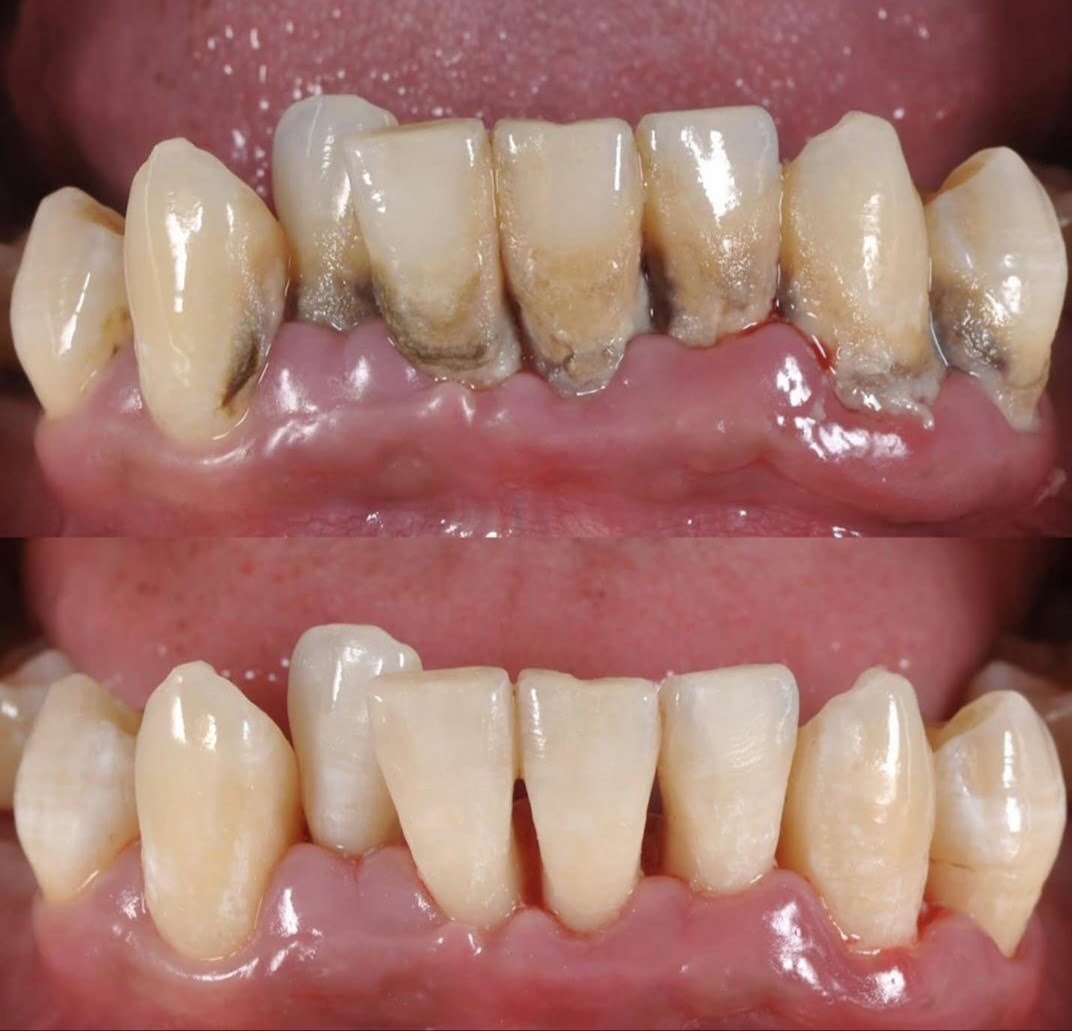 Gum Treatment