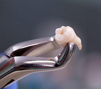 Tooth extraction