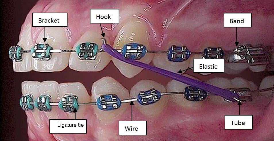 Risks of Dental Braces